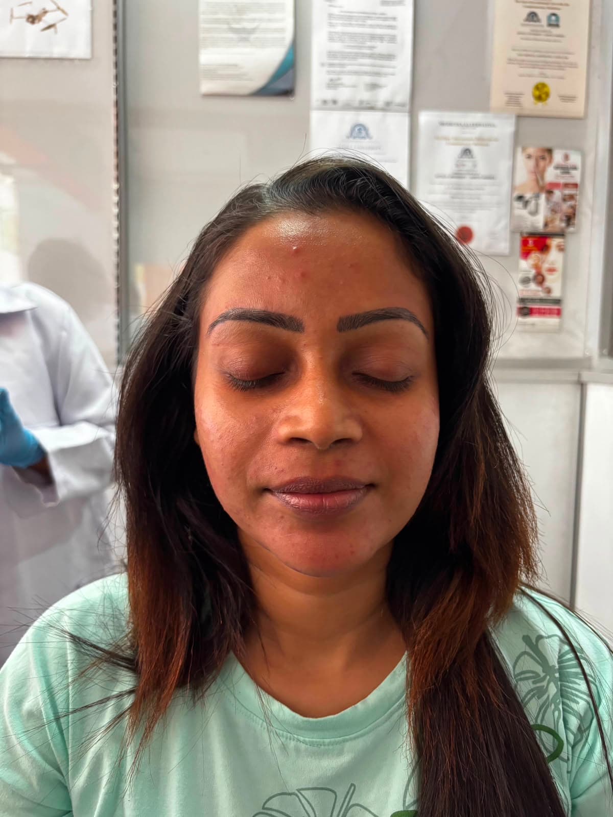 Carbon Laser Peel, after