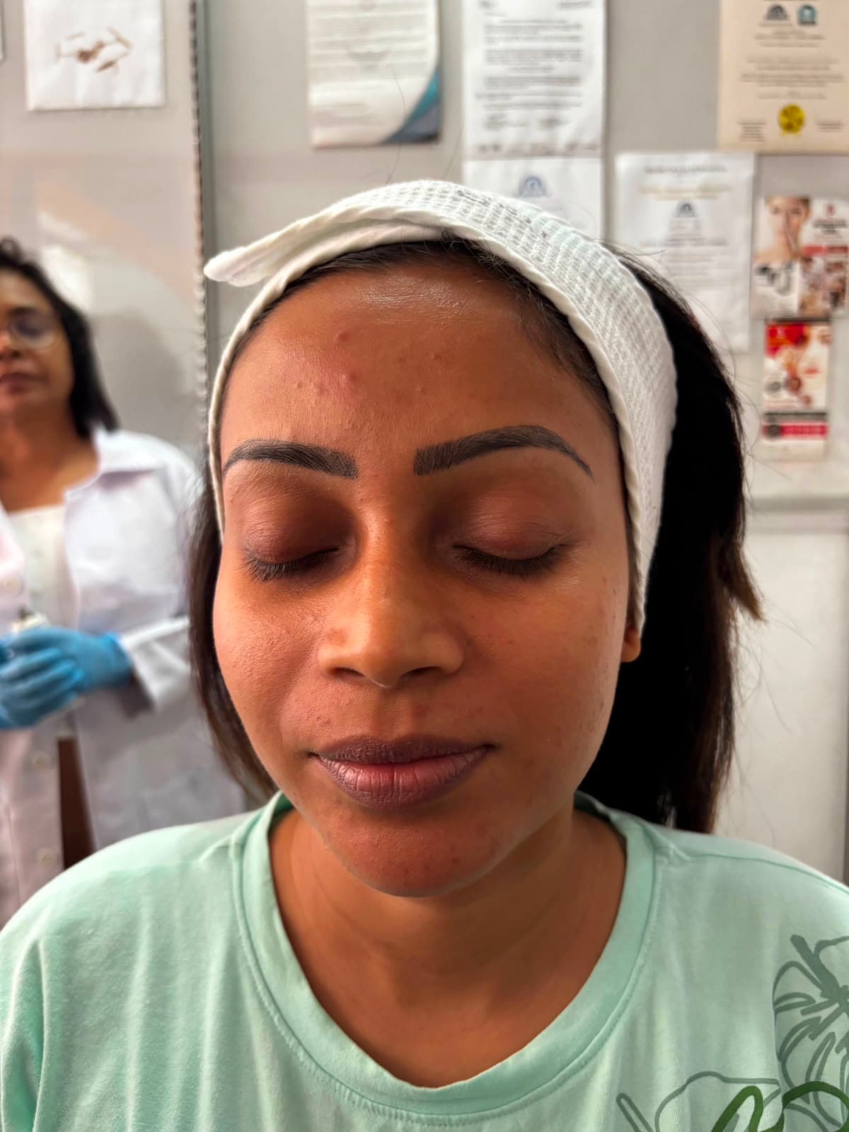 Carbon Laser Peel, before